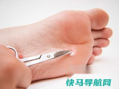 如何用鸡眼贴治疗鸡眼 第2张